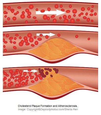 Atherosclerosis 1 Canadian Academy of Sports Nutrition caasn
