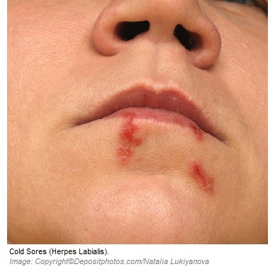 Cold sore 1 Canadian Academy of Sports Nutrition caasn